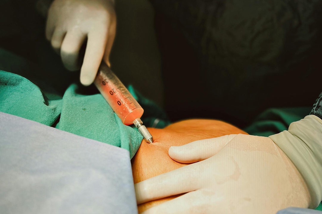 Fehler bei der Liposuktion