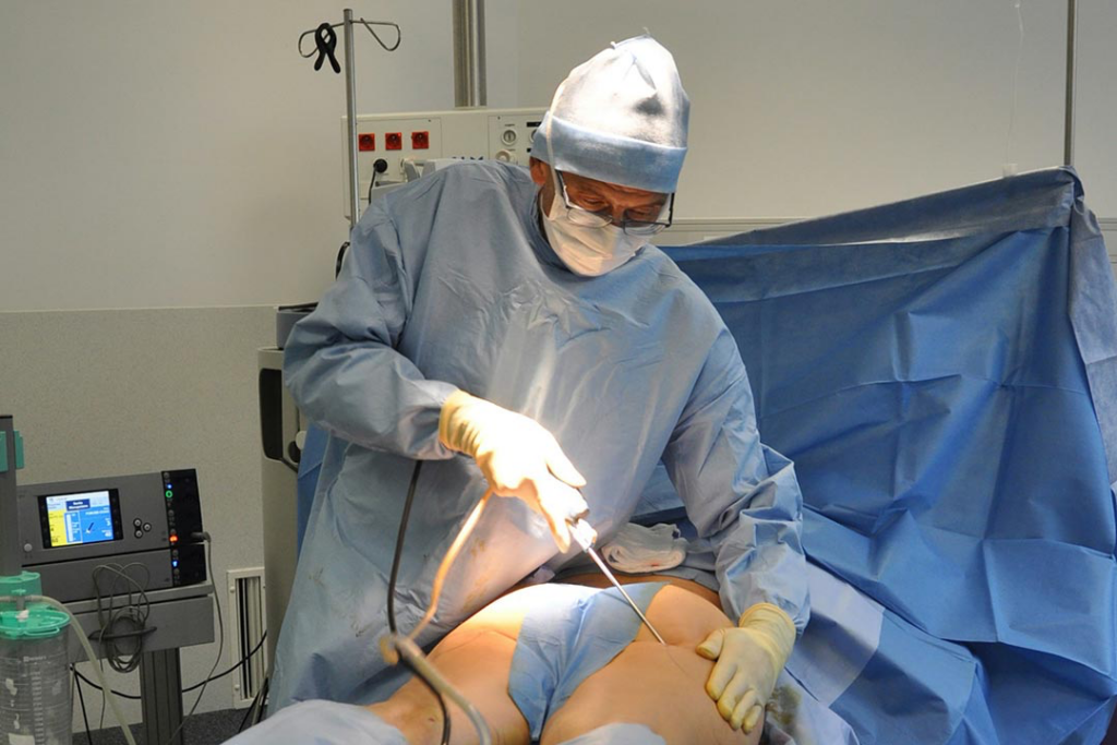 Fehler bei Liposuktion