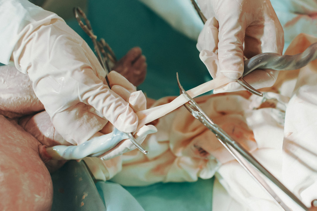 Durchtrennen der Nabelschnur - Blutgasanalyse nach der Geburt
